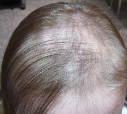 teen hair loss treatment